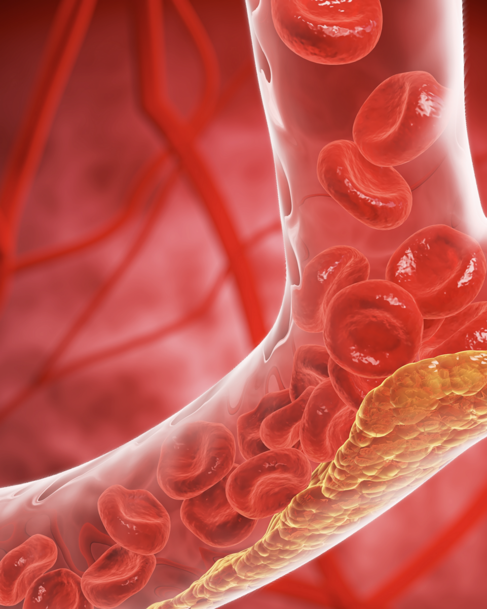 Blood Flow Restriction (BFR) Therapy