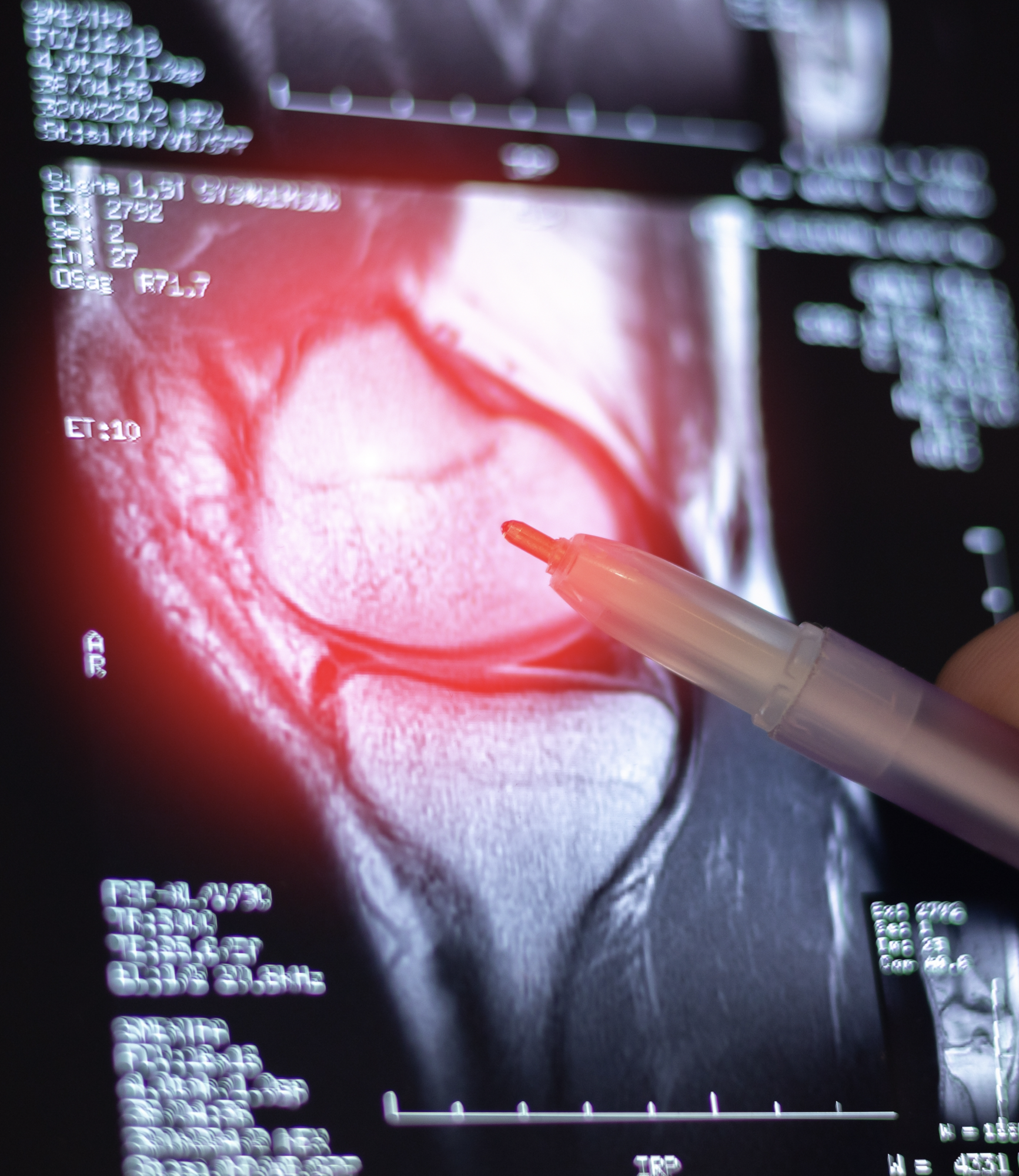 Knee Osteoarthritis