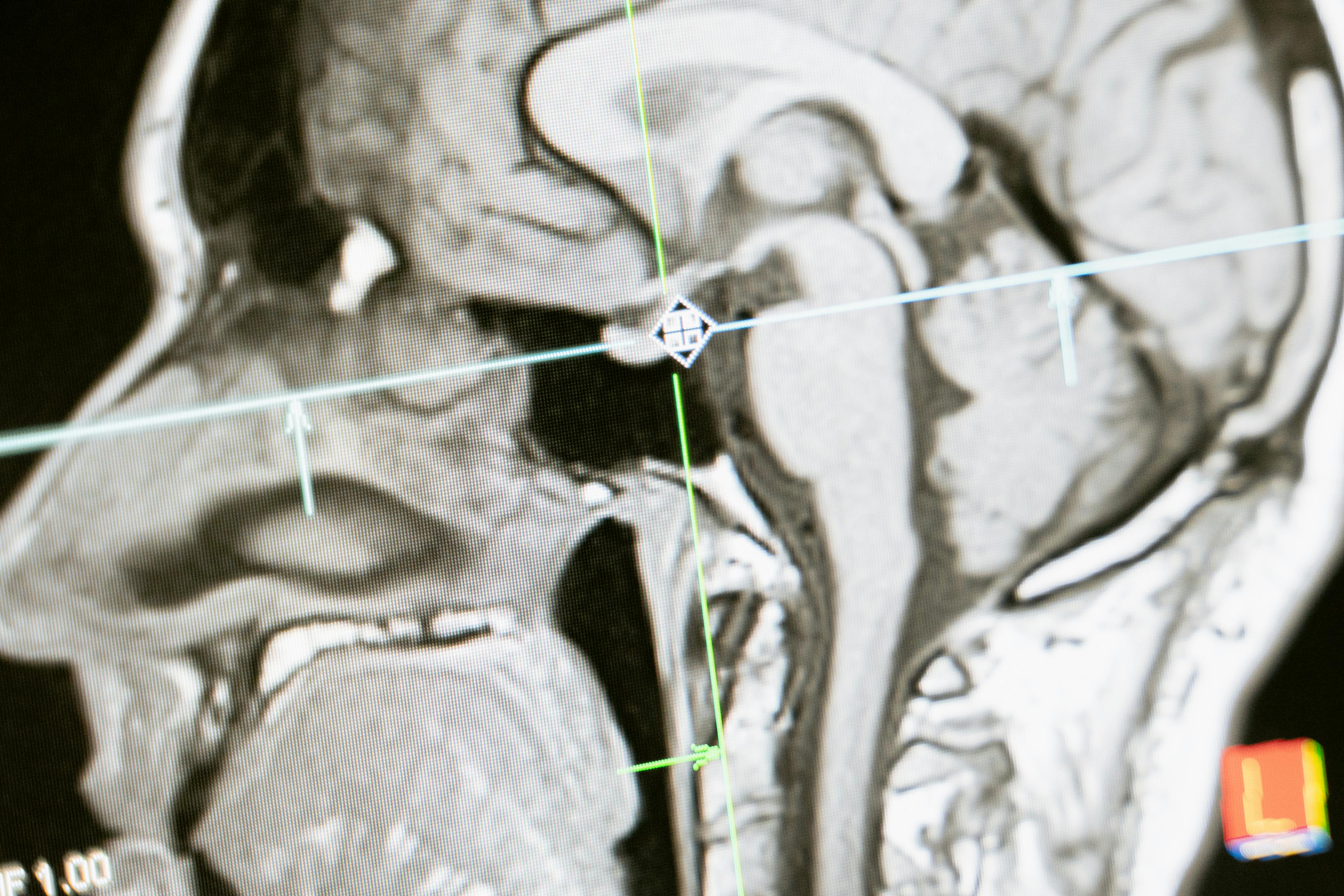 Concussion Care