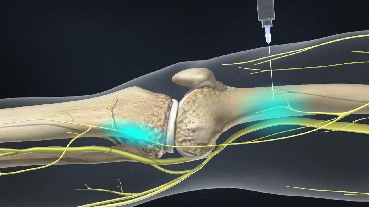 Nerve Pain