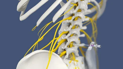 Nerve Blocks & Radiofrequency Ablation